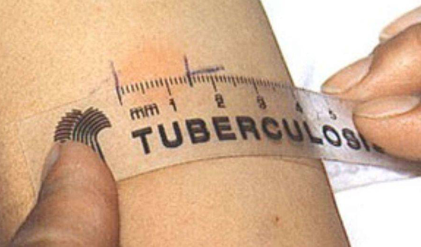 4.7 million lei will be allocated for tuberculosis prevention